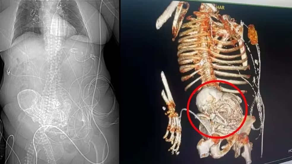 Tomografia mostra como 'bebê de pedra' estava no abdômen de idosa, em Ponta Porã (MS)